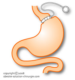 anneau gastrique